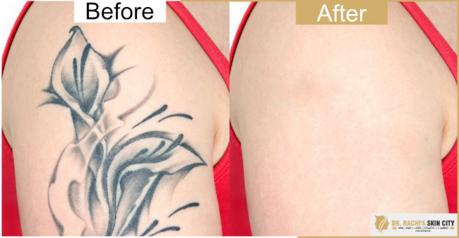 Dr.Rachi's Skin City | Laser Tattoo Removal Treatment in Vadodara | Laser  Tattoo Removal Doctor in Vadodara | Laser Tattoo Removal Specialist in  Vadodara | Doctors for tattoo removal in Vadodara